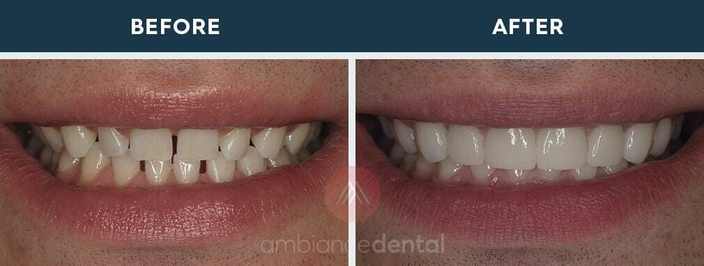 ambiance-dental-before-after-04