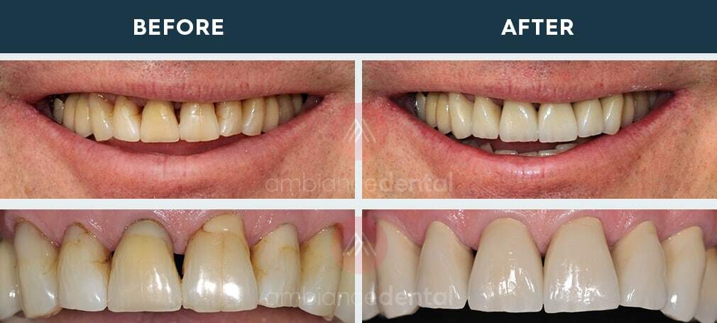 ambiance-dental-before-after-08