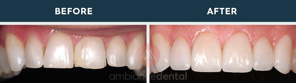 ambiance-dental-before-after-12