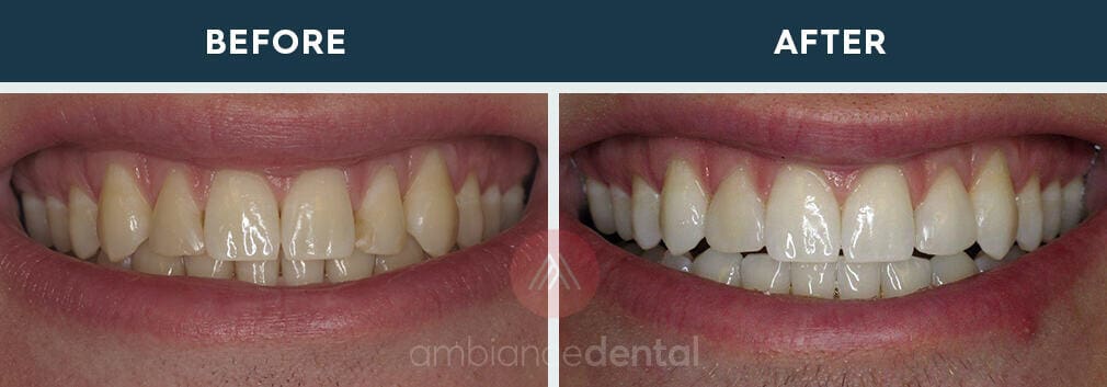 ambiance-dental-before-after-18