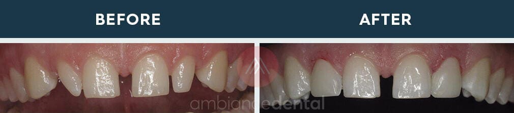ambiance-dental-before-after-24