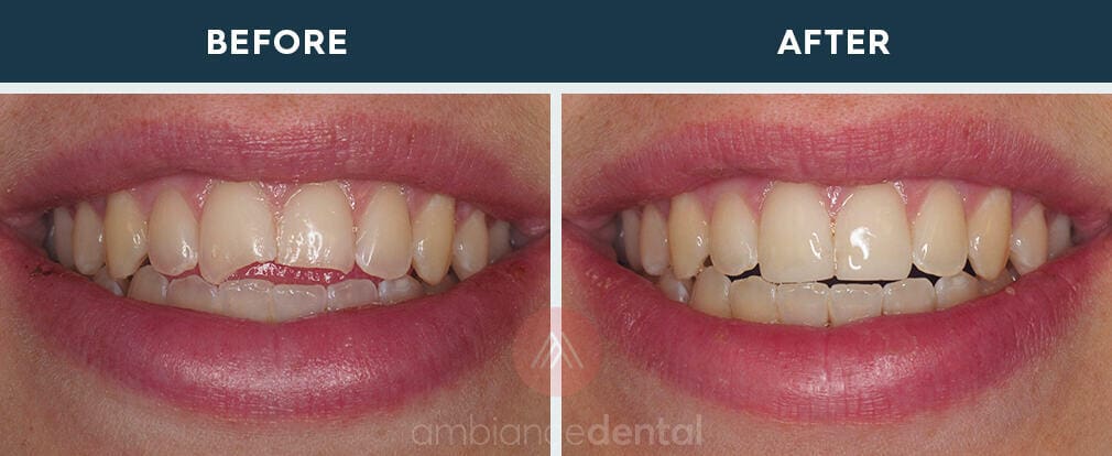ambiance-dental-before-after-28
