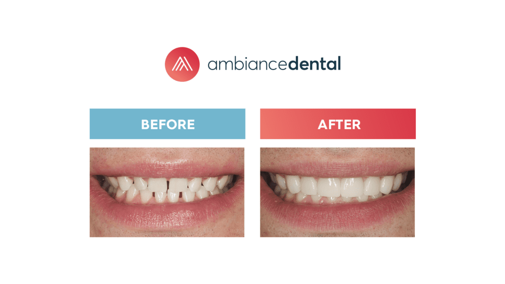 What are the Elements of the Perfect Smile? • Ambiance Dental