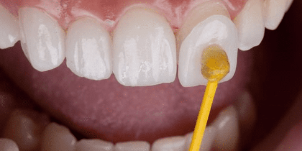 What Are Dental Veneers?