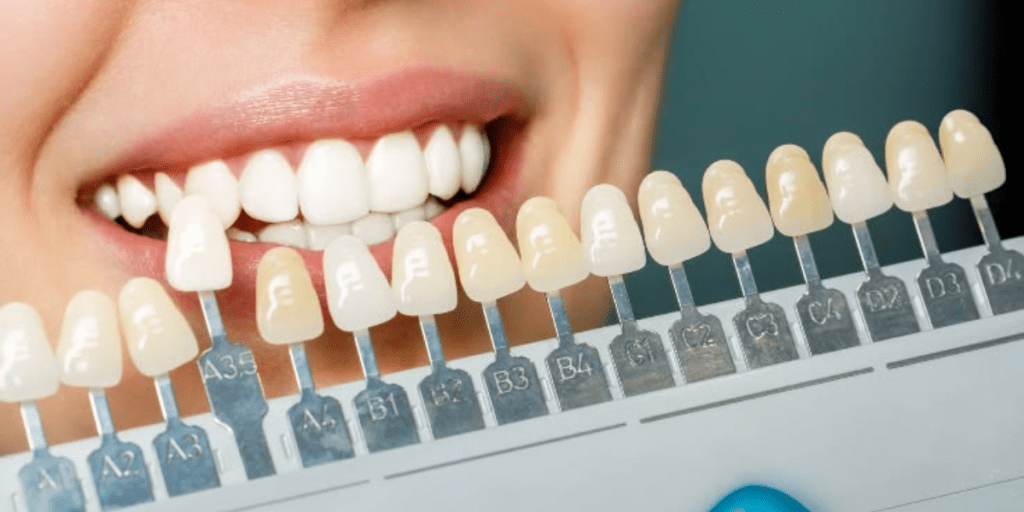 Are Dental Veneers Permanent?