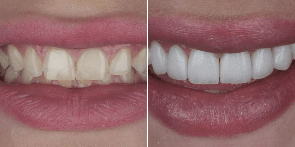 Veneers vs Composite Bonding